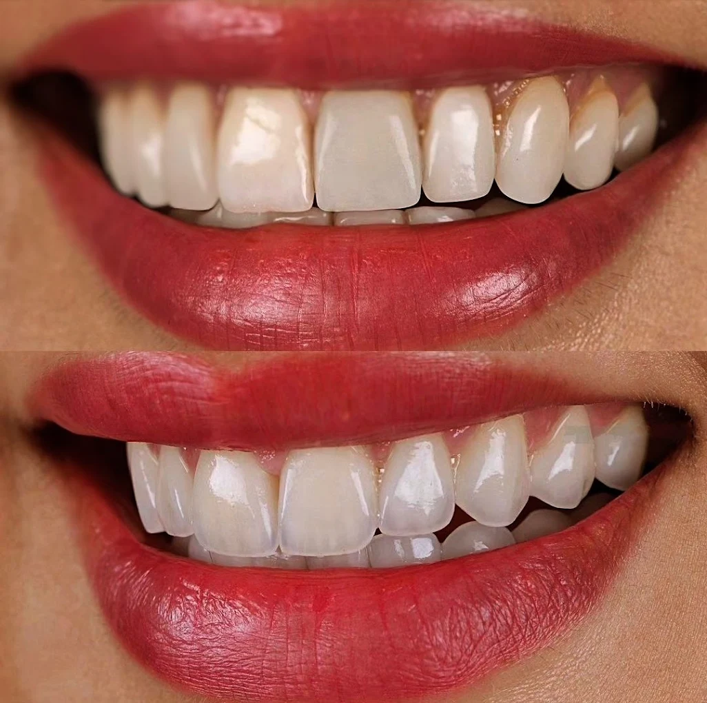 Aesthetic smile transformation result